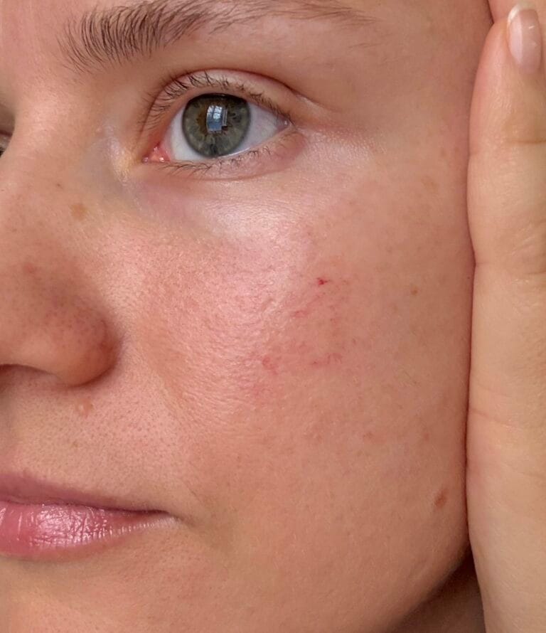 Kuperoosa ja näoõli: kas tohib kasutada?